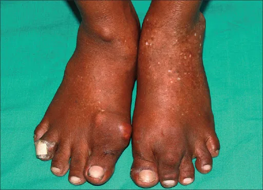 Educational image associated with Gout