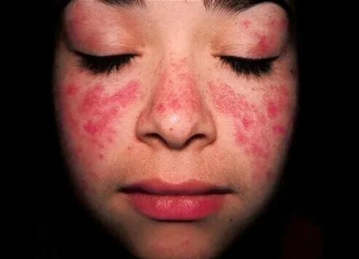 Educational image associated with Systemic Lupus Erythematosus