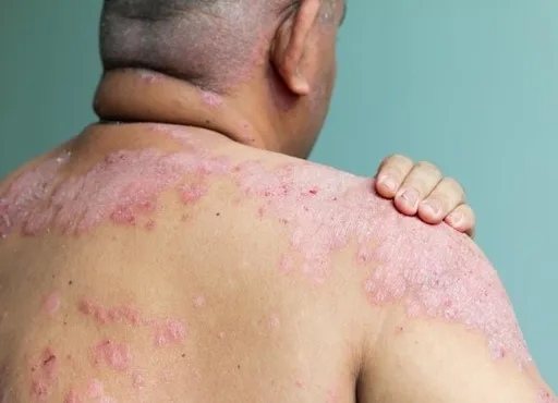 Educational image associated with Psoriatic Arthritis