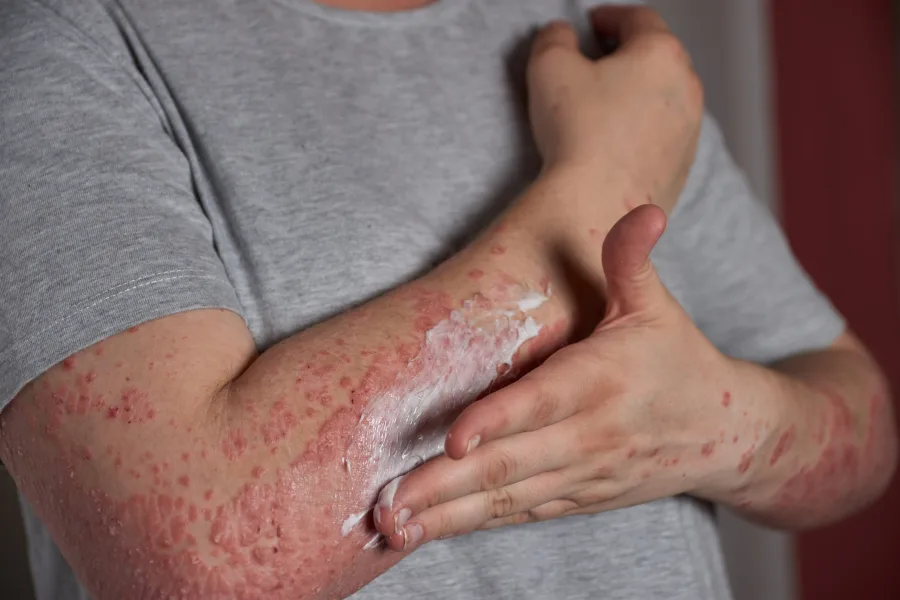 Educational image associated with Sjögren's Syndrome