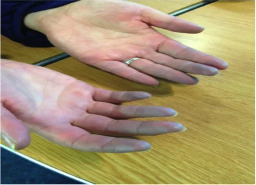 Educational image associated with Spondyloarthritis
