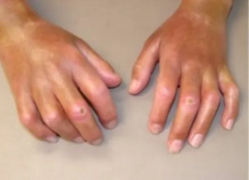 Educational image associated with Systemic Sclerosis
